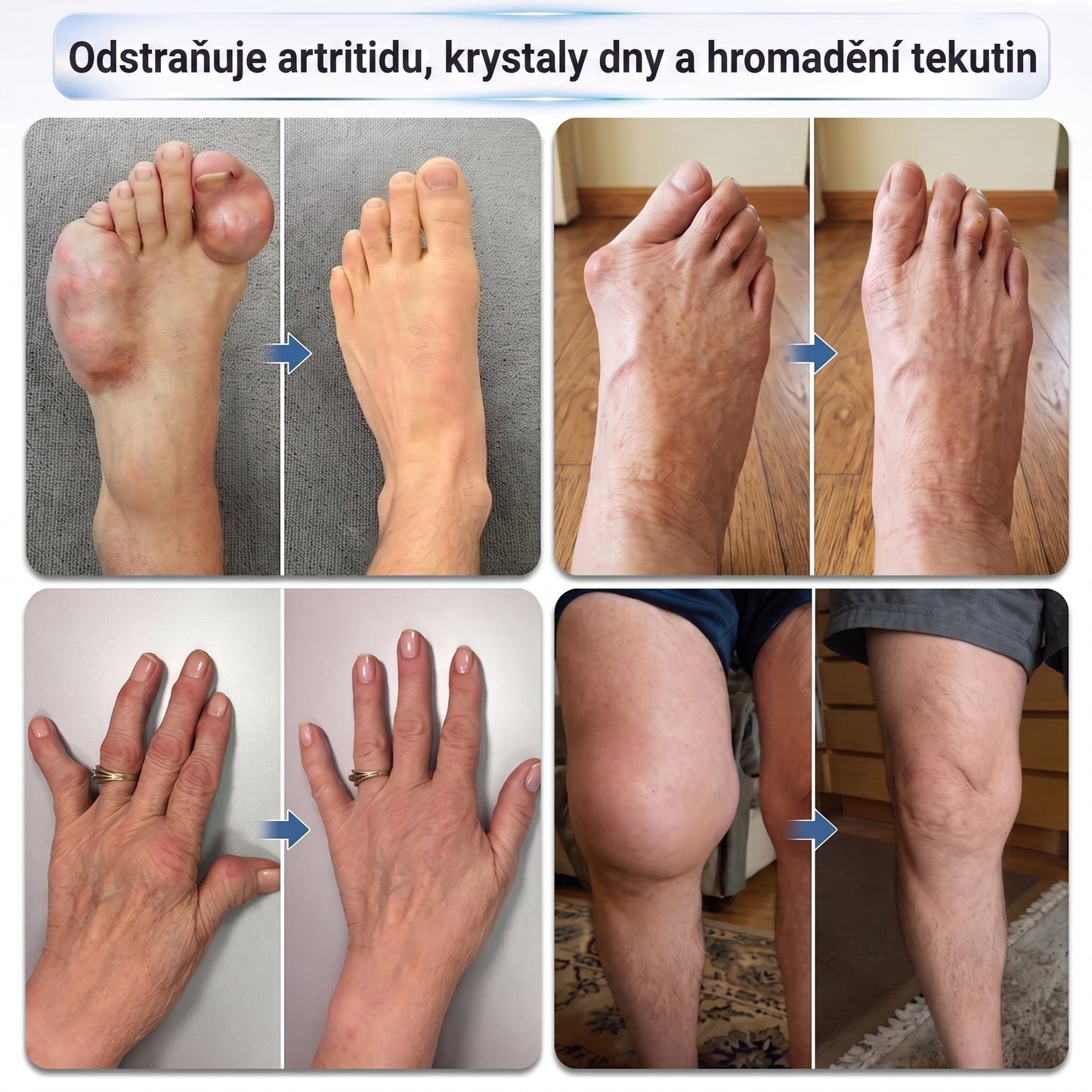OFICIÁLNÍ OBCHOD | IFMAGIC® 0,05 mm Mikroneedle Rychle Působící Roll-On pro Úlevu Kloubů a Kostí🎇