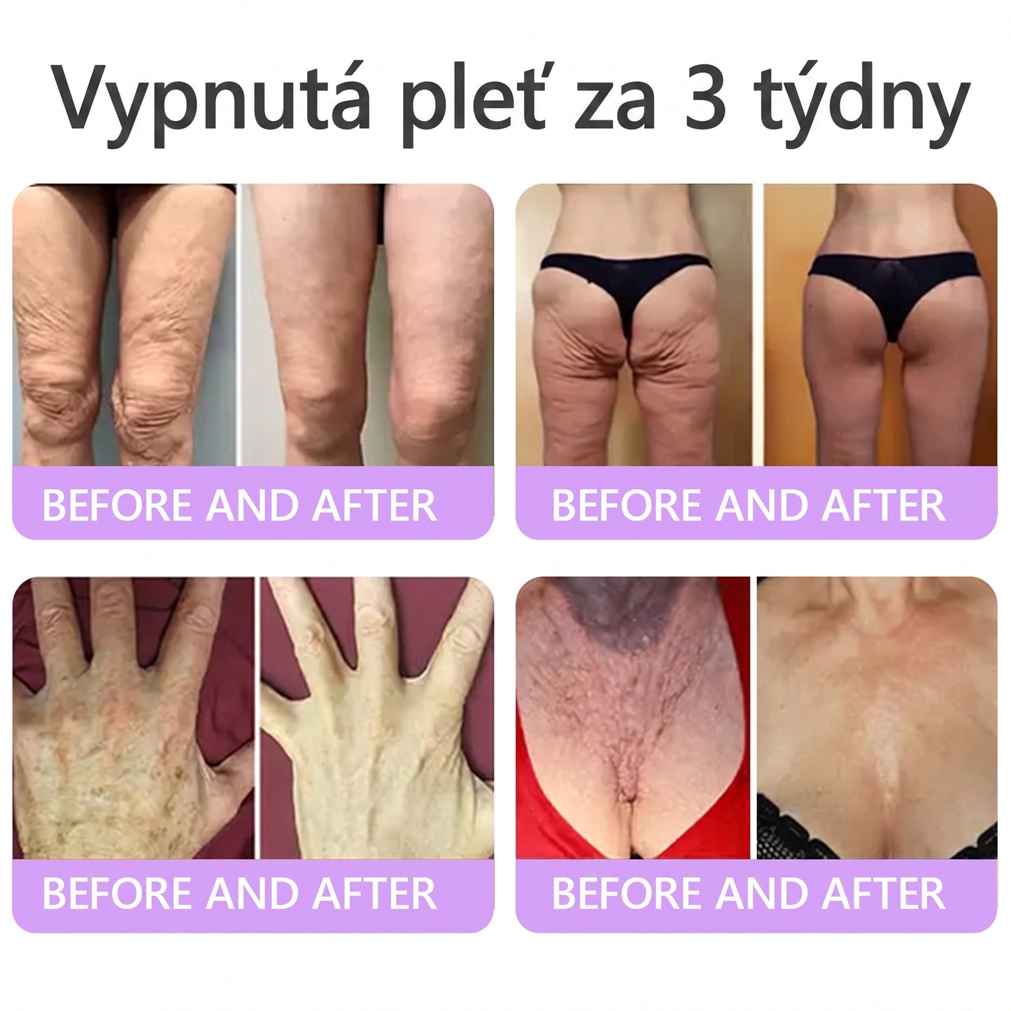 Doporučováno dermatology🥇 | 🍗𝐋𝐮𝐦𝐨𝐫𝐢𝐞® PDRN Multi-Peptidový masážní tělový krém – Proti stárnutí, hydratační, zpevňující, regenerační, sjednocující, proti akné a skvrnám, na odstraňování bradavic a mateřských znamének, pro úlevu při lupénce.❤️