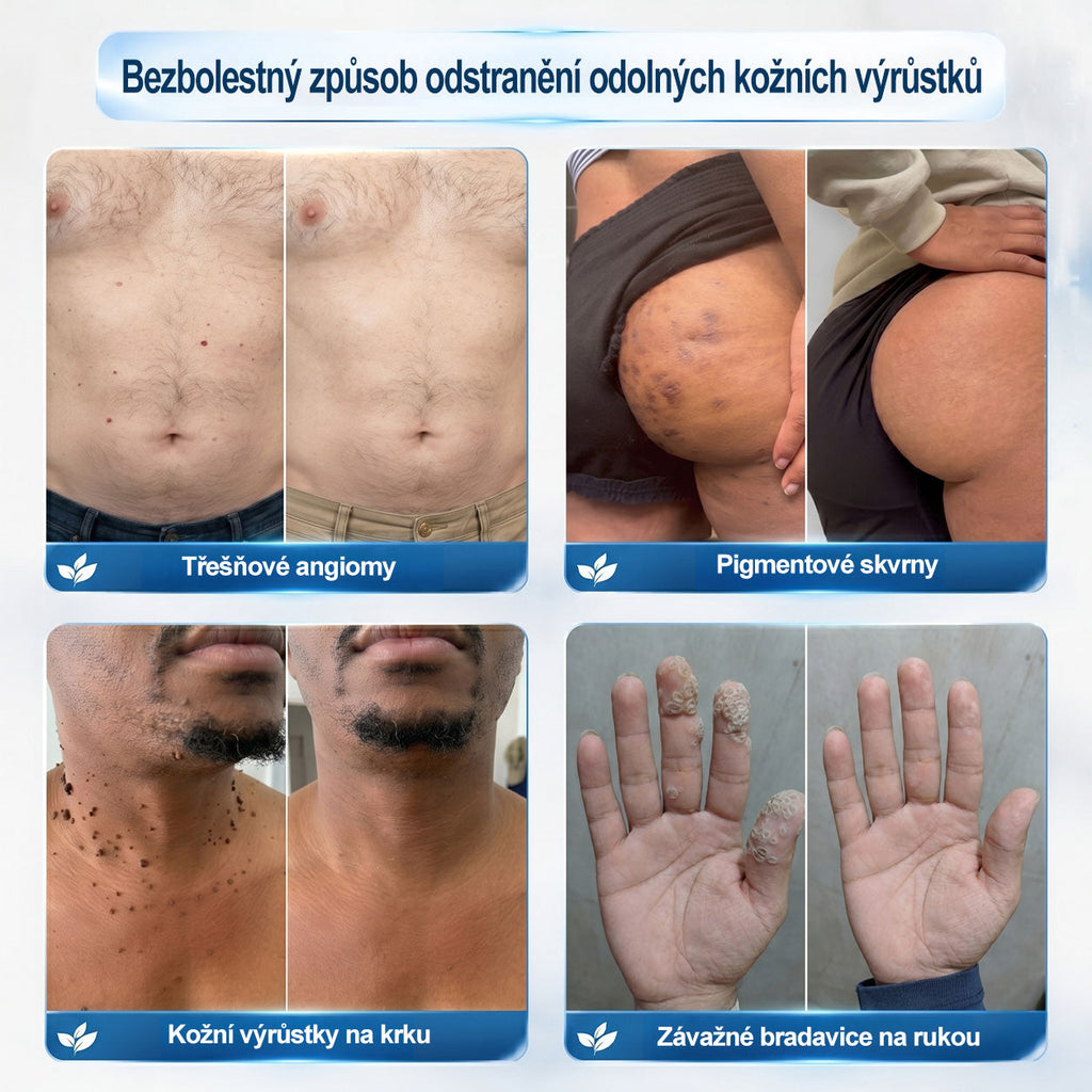 Oficjalny sklep marki |👩‍⚕️𝐏𝐢𝐜𝑑𝑜® 𝟕-𝐝𝐧𝐢𝐨𝐰𝐲 𝐤𝐨𝐫𝐞𝐤𝐭𝐨𝐫 𝐩𝐥𝐚𝐦 𝐢 𝐩𝐫𝐳𝐞𝐛𝐚𝐫𝐰𝐢𝐞ń (Bezbolesny aplikator kulkowy, bez blizn)✈️