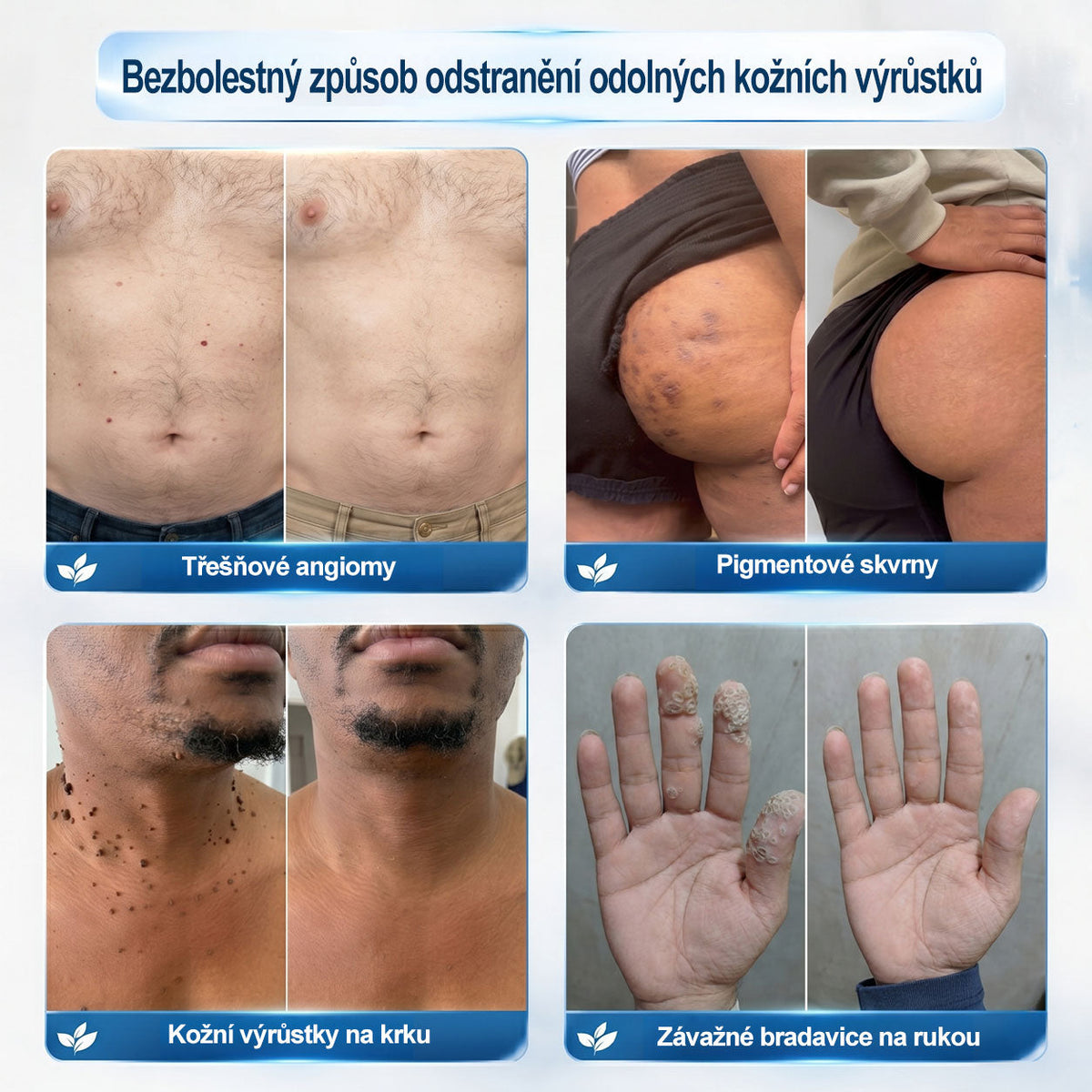 Oficiální značkový obchod |🌻𝐏𝐢𝐜𝑑𝑜® 𝟩𝖽𝖾𝗻𝗻í 𝘰𝘥𝘴𝘵𝗋𝖺ň𝗈𝗏𝖺č 𝒔𝒌𝒗𝒓𝙣 𝙖 𝙥𝙞𝙜𝙢𝙚𝙣𝙩𝘰𝘷ý𝘤𝘩 𝘴𝘬𝖛𝖗𝖓 (Bezbolestný rollerball bez jizev)