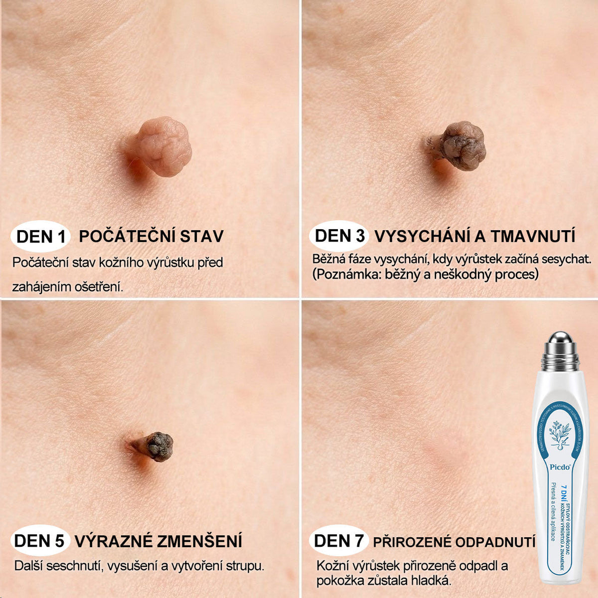 Oficjalny sklep marki |👩‍⚕️𝐏𝐢𝐜𝑑𝑜® 𝟕-𝐝𝐧𝐢𝐨𝐰𝐲 𝐤𝐨𝐫𝐞𝐤𝐭𝐨𝐫 𝐩𝐥𝐚𝐦 𝐢 𝐩𝐫𝐳𝐞𝐛𝐚𝐫𝐰𝐢𝐞ń (Bezbolesny aplikator kulkowy, bez blizn)✈️