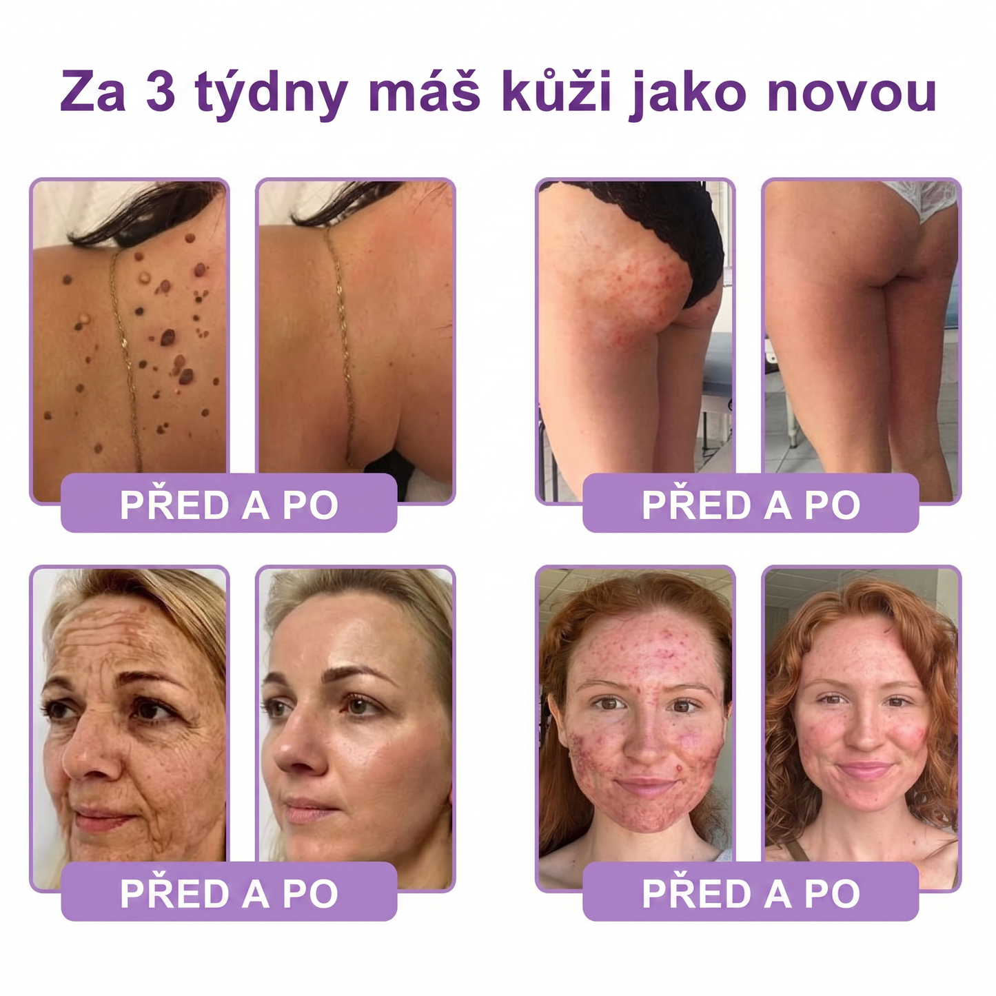 Doporučováno dermatology🥇 | 🍗𝐋𝐮𝐦𝐨𝐫𝐢𝐞® PDRN Multi-Peptidový masážní tělový krém – Proti stárnutí, hydratační, zpevňující, regenerační, sjednocující, proti akné a skvrnám, na odstraňování bradavic a mateřských znamének, pro úlevu při lupénce.❤️