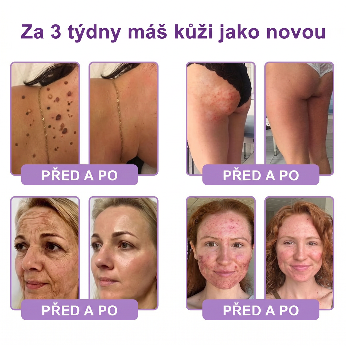 Doporučováno dermatology🥇 | 🍗𝐋𝐮𝐦𝐨𝐫𝐢𝐞® PDRN Multi-Peptidový masážní tělový krém – Proti stárnutí, hydratační, zpevňující, regenerační, sjednocující, proti akné a skvrnám, na odstraňování bradavic a mateřských znamének, pro úlevu při lupénce.❤️
