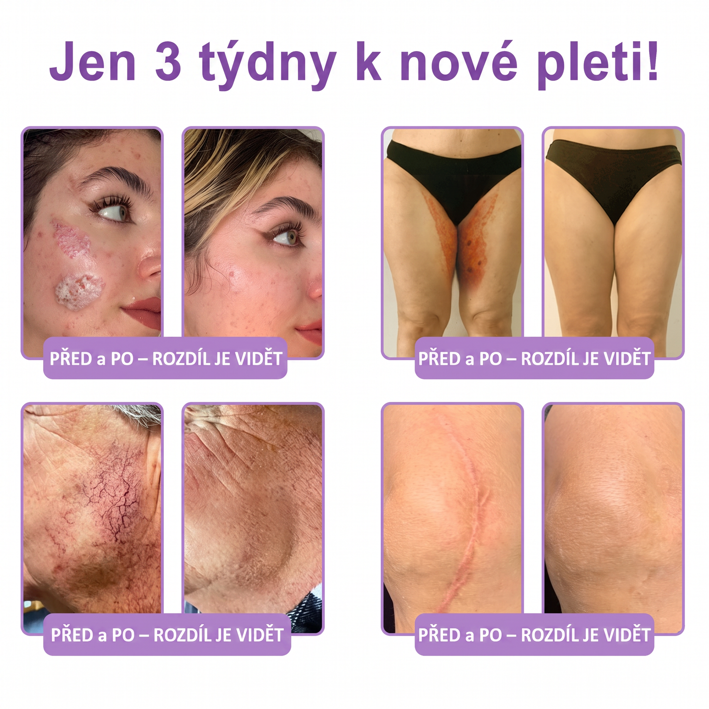 Doporučováno dermatology🥇 | 🍗𝐋𝐮𝐦𝐨𝐫𝐢𝐞® PDRN Multi-Peptidový masážní tělový krém – Proti stárnutí, hydratační, zpevňující, regenerační, sjednocující, proti akné a skvrnám, na odstraňování bradavic a mateřských znamének, pro úlevu při lupénce.❤️
